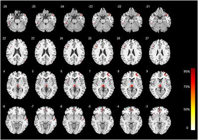 Characterizing the Structural Pattern of Heavy Smokers Using Multivoxel Pattern Analysis